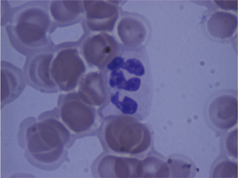 PB smear. Dysplastic neutrophils